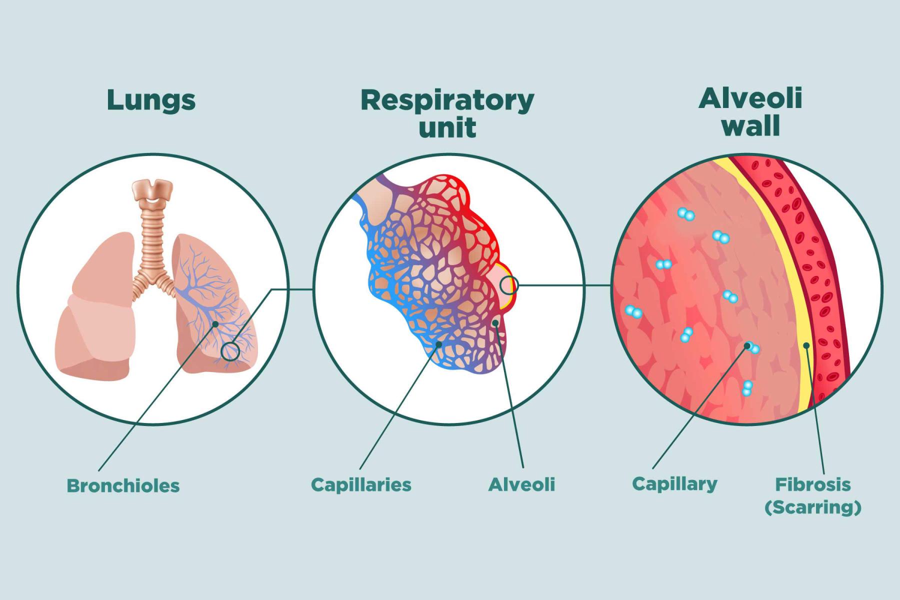 Pulmonary Fibrosis stages